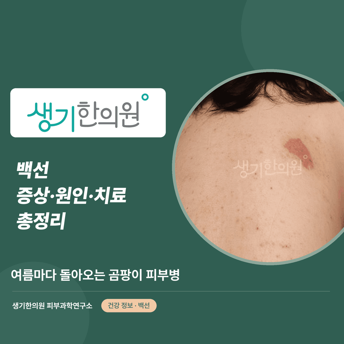 백선 증상·원인·치료 총정리 대표 이미지