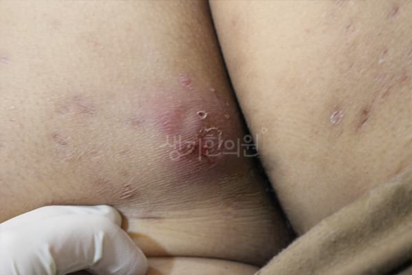 화농성한선염 치료 전 사진 — 수원점, 치료 기간 3개월