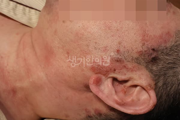 지루성피부염 치료 전 사진 — 분당점, 치료 기간 5개월