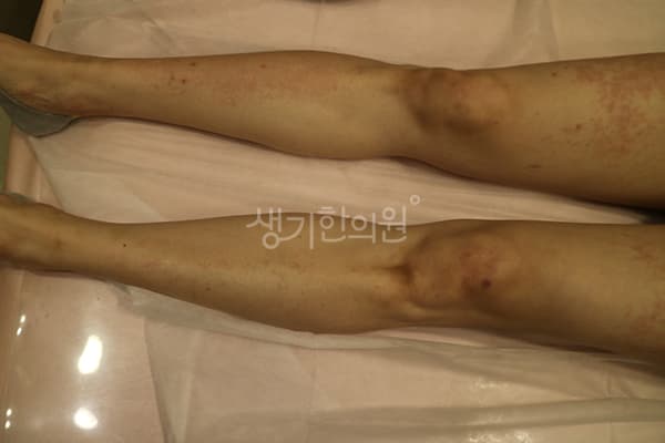 두드러기 치료 전 사진 — 분당점, 치료 기간 3개월