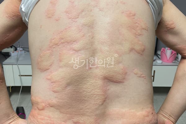 두드러기 치료 전 사진 — 대전점, 치료 기간 5개월