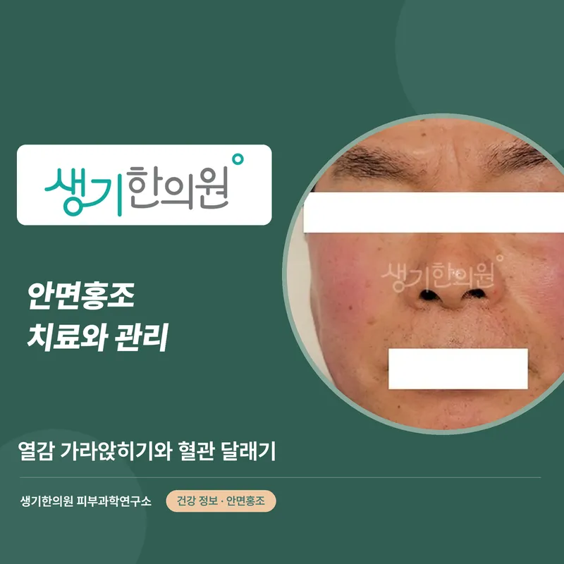 안면홍조 치료와 관리 — 열감 가라앉히기와 혈관 달래기 대표 이미지
