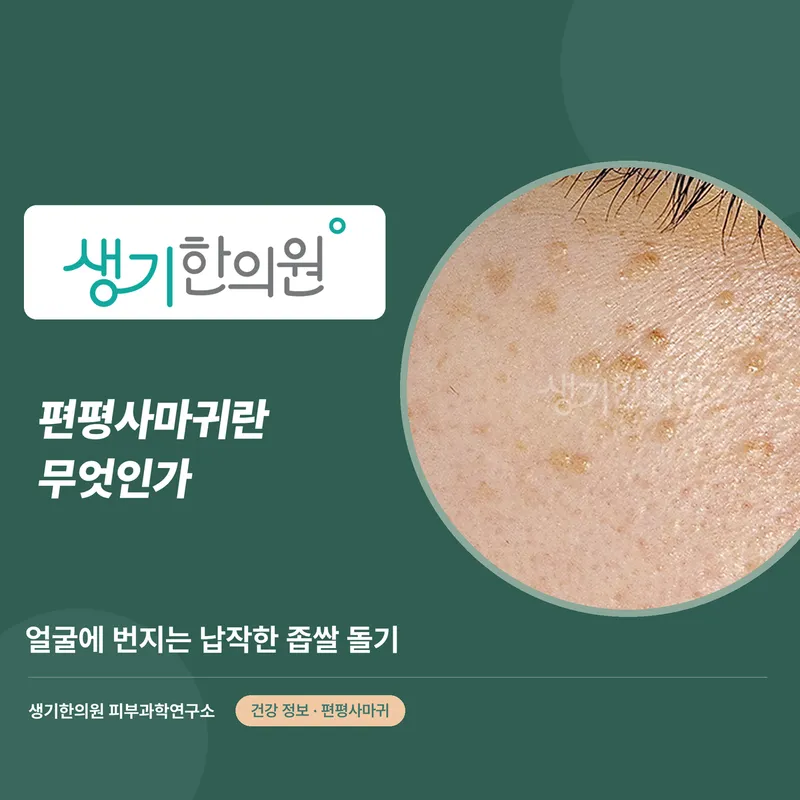 편평사마귀란 무엇인가 — 얼굴에 번지는 납작한 좁쌀 돌기 대표 이미지