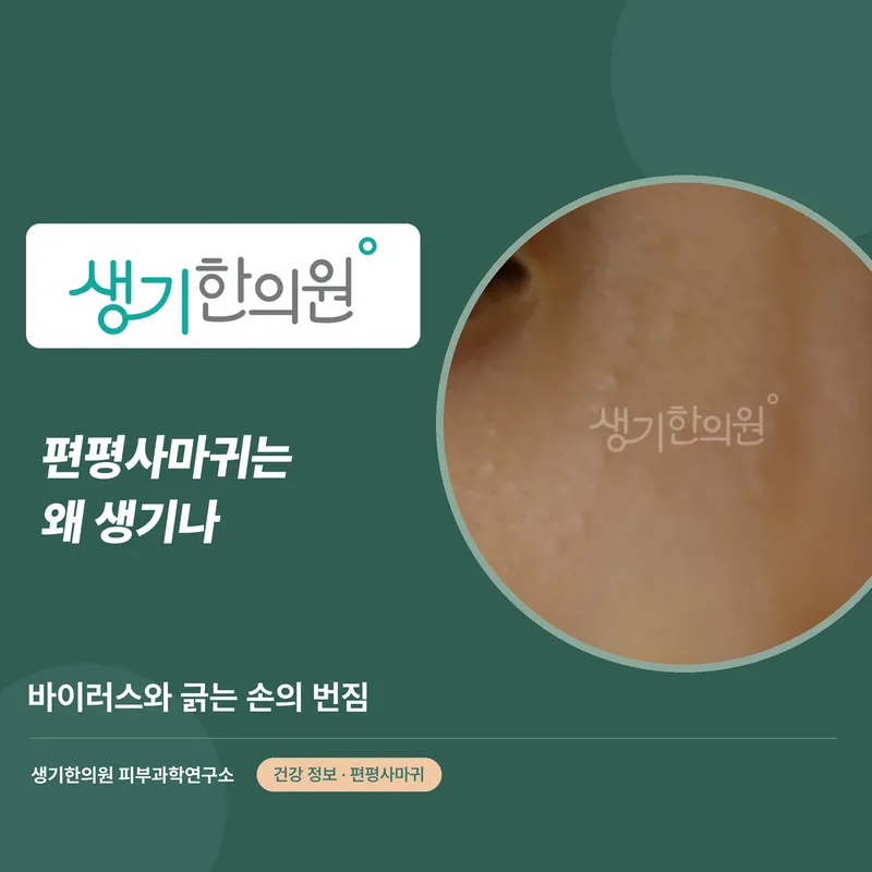 편평사마귀는 왜 생기나 — 바이러스와 긁는 손의 번짐 대표 이미지