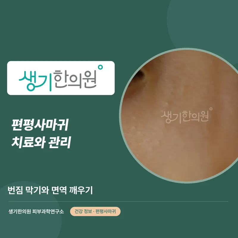 편평사마귀 치료와 관리 — 번짐 막기와 면역 깨우기 대표 이미지