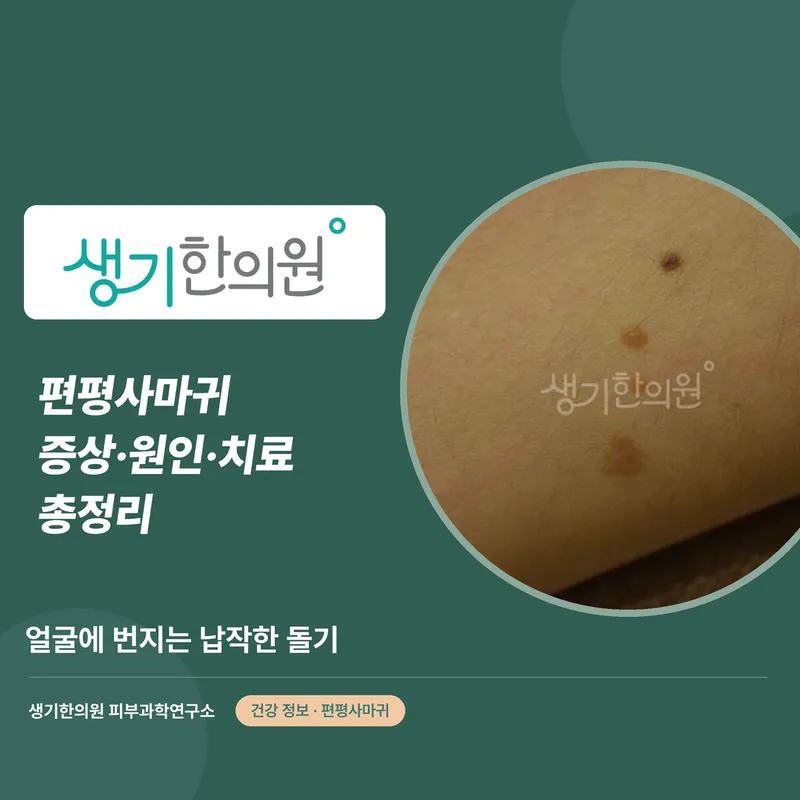 편평사마귀 증상·원인·치료 총정리 대표 이미지
