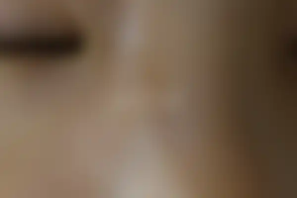 편평사마귀 치료 후 사진 — 광주점, 치료 기간 4개월
