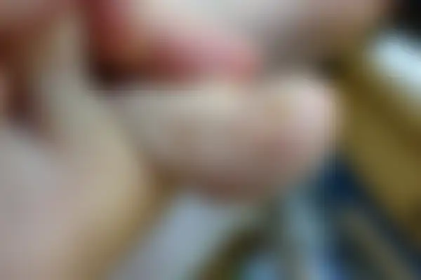 사마귀 치료 후 사진 — 노원점, 치료 기간 6개월