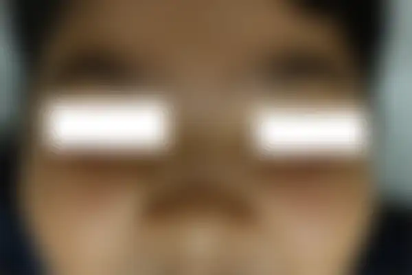 사마귀 치료 후 사진 — 부천점, 치료 기간 3개월