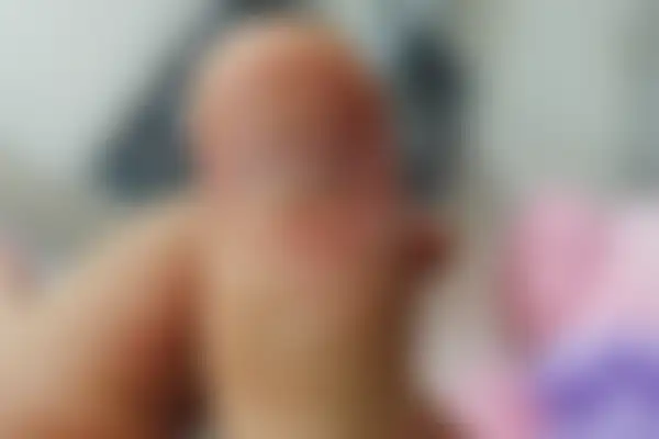 사마귀 치료 후 사진 — 부천점, 치료 기간 3개월