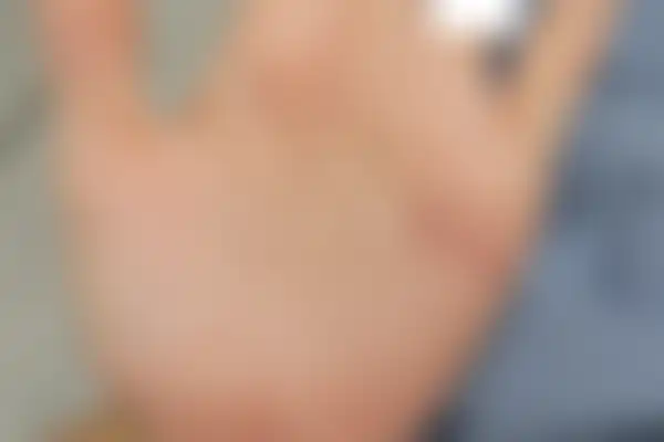 한포진 치료 후 사진 — 마포공덕점, 치료 기간 3개월