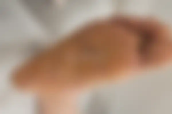 한포진 치료 후 사진 — 마포공덕점, 치료 기간 6개월