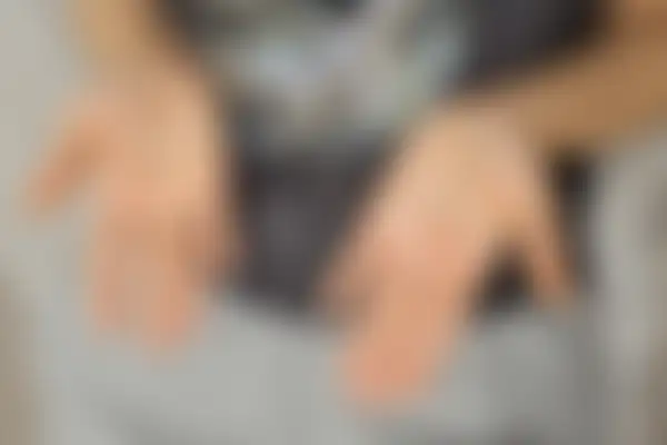 한포진 치료 후 사진 — 마포공덕점, 치료 기간 6개월