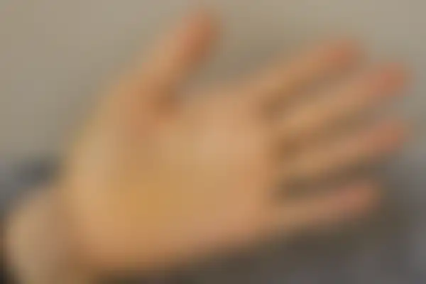 한포진 치료 후 사진 — 수원점, 치료 기간 9개월