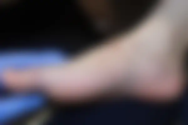한포진 치료 후 사진 — 천안아산점, 치료 기간 4개월