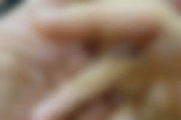 한포진 치료 후 사진 — 노원점, 치료 기간 4개월