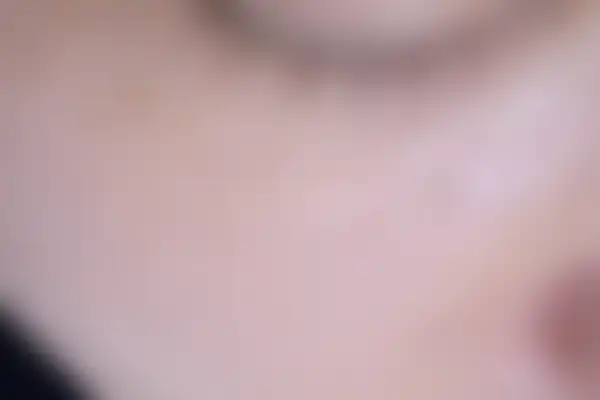 편평사마귀 치료 후 사진 — 대전점, 치료 기간 3개월