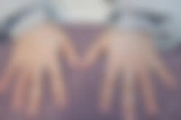 한포진 치료 후 사진 — 천안아산점, 치료 기간 4개월