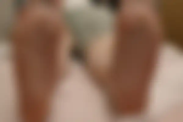 한포진 치료 후 사진 — 분당점, 치료 기간 4개월