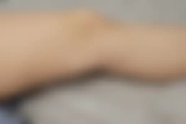 편평사마귀 치료 후 사진 — 마포공덕점, 치료 기간 4개월