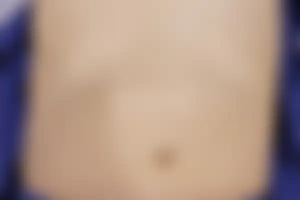 편평사마귀 치료 후 사진 — 마포공덕점, 치료 기간 9개월