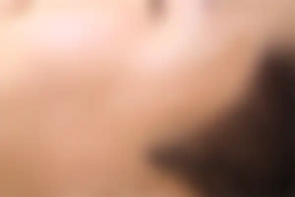 편평사마귀 치료 후 사진 — 안산점, 치료 기간 4개월