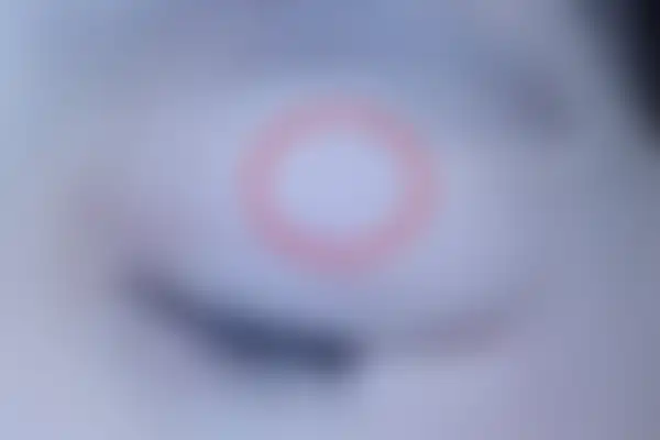편평사마귀 치료 후 사진 — 천안아산점, 치료 기간 3개월