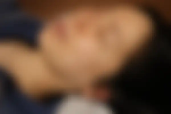 편평사마귀 치료 후 사진 — 분당점, 치료 기간 6개월