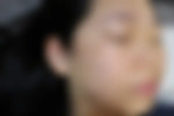 지루성피부염 치료 후 사진 — 수원점, 치료 기간 4개월