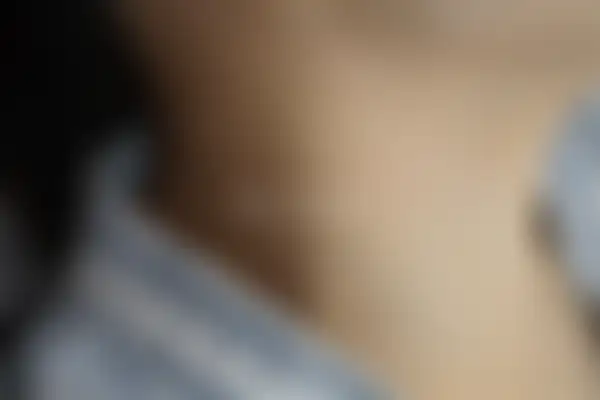 편평사마귀 치료 후 사진 — 부산센텀점, 치료 기간 3개월