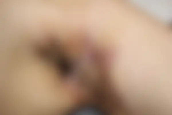 화농성한선염 치료 후 사진 — 수원점, 치료 기간 3개월