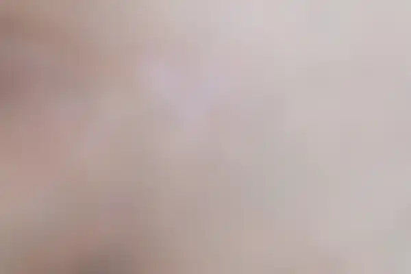 곤지름 치료 후 사진 — 천안아산점, 치료 기간 3개월