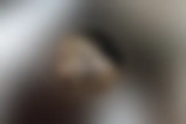 곤지름 치료 후 사진 — 광주점, 치료 기간 3개월