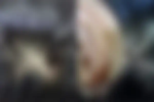 지루성피부염 치료 후 사진 — 광주점, 치료 기간 4개월