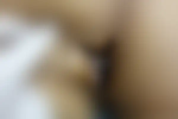 곤지름 치료 후 사진 — 광주점, 치료 기간 5개월