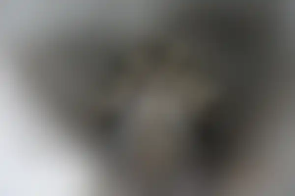 곤지름 치료 후 사진 — 광주점, 치료 기간 13개월