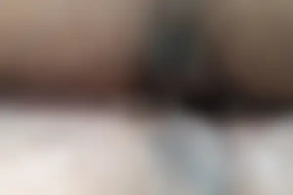 곤지름 치료 후 사진 — 신도림점, 치료 기간 4개월