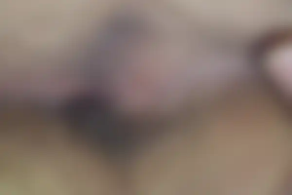 곤지름 치료 후 사진 — 천안아산점, 치료 기간 3개월