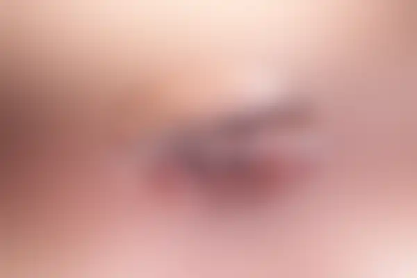곤지름 치료 후 사진 — 신도림점, 치료 기간 3개월