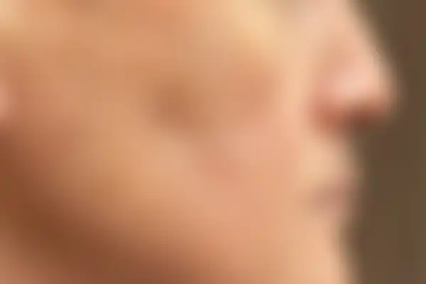 안면홍조 치료 후 사진 — 잠실점, 치료 기간 3개월