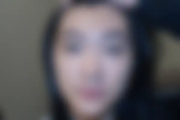 안면홍조 치료 후 사진 — 천안아산점, 치료 기간 3개월