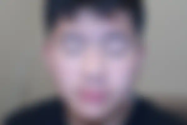 안면홍조 치료 후 사진 — 천안아산점, 치료 기간 4개월