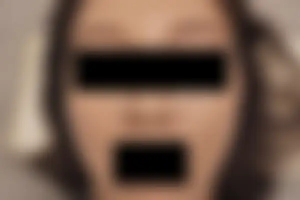 안면홍조 치료 후 사진 — 마포공덕점, 치료 기간 3개월