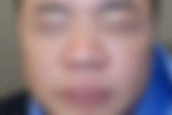 안면홍조 치료 후 사진 — 천안아산점, 치료 기간 3개월