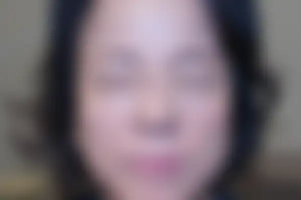 안면홍조 치료 후 사진 — 천안아산점, 치료 기간 3개월