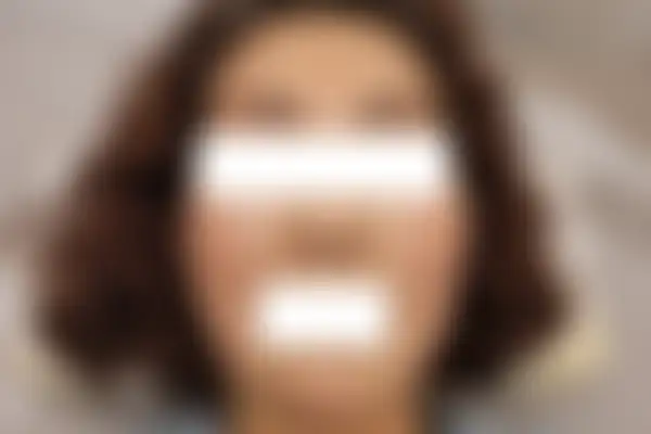 안면홍조 치료 후 사진 — 마포공덕점, 치료 기간 3개월