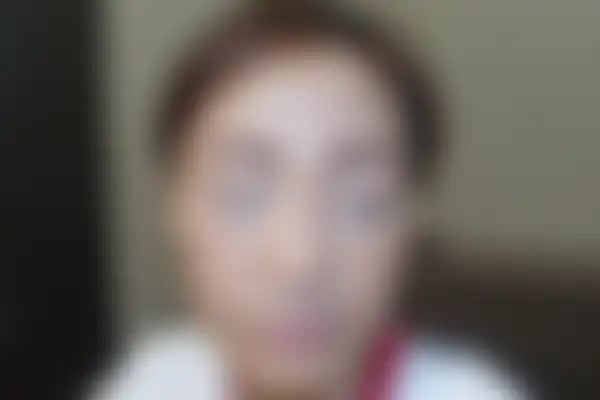 안면홍조 치료 후 사진 — 천안아산점, 치료 기간 3개월