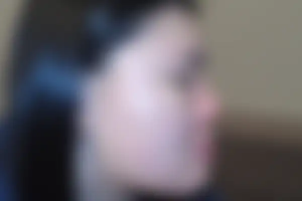 여드름 치료 후 사진 — 천안아산점, 치료 기간 3개월