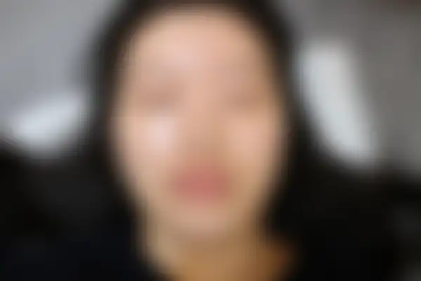여드름 치료 후 사진 — 수원점, 치료 기간 9개월