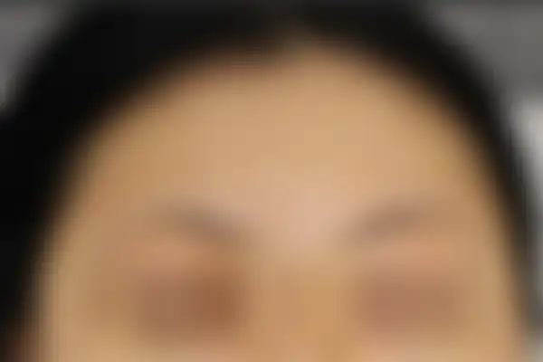 여드름 치료 후 사진 — 안산점, 치료 기간 5개월